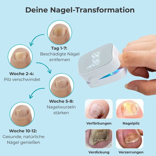 RevitaNail Nagelpilz Therapie