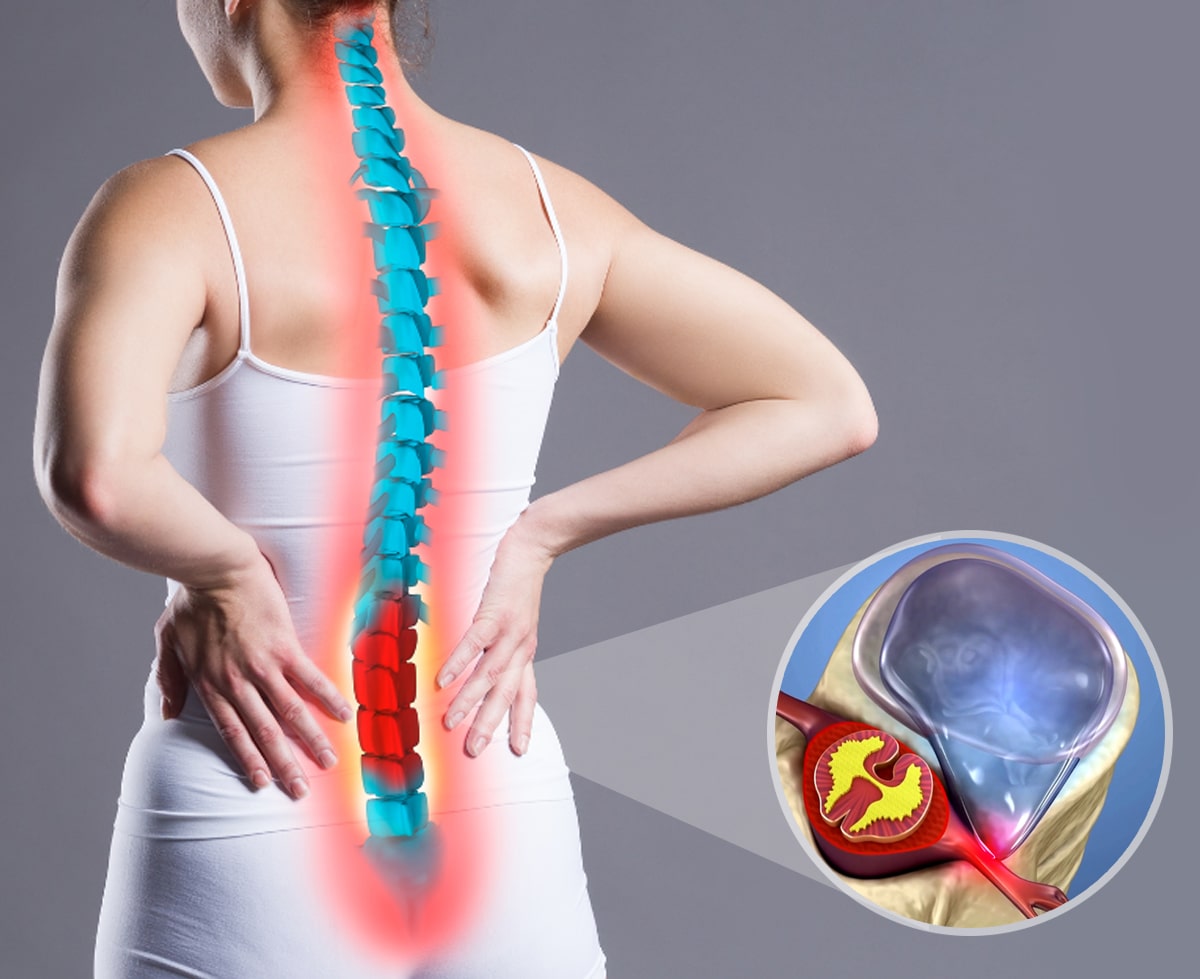 Die Wahren Auslöser von Ischias und Rückenschmerzen: Warum Chirurgie nicht die Lösung ist